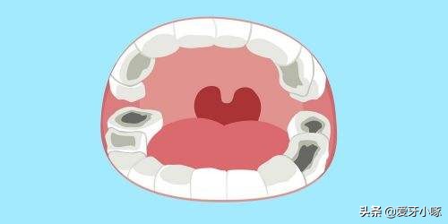 牙齿吃冷热东西疼痛怎么治疗,吃东西牙齿又酸又疼是什么原因