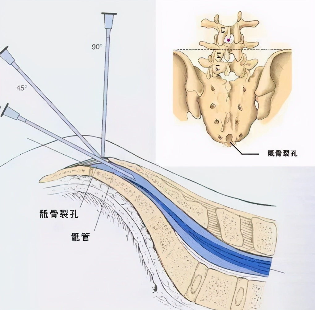 做了痔疮手术肿一直消不下去,痔疮手术后腿动不了是什么原因