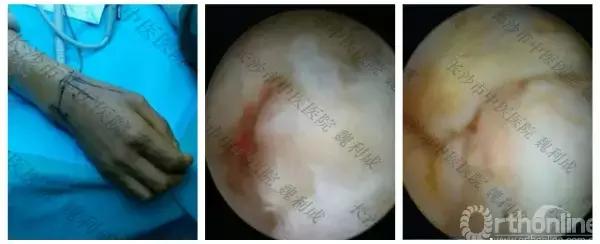 手腕囊肿抽吸出来后可否继续按压,足背囊肿穿刺好还是切除好