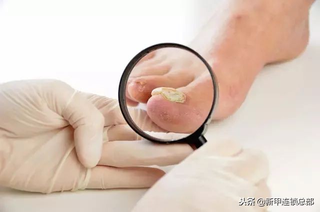 因为灰指甲，被儿媳嫌弃，不让带孙子，幼儿园被退学！新甲连锁