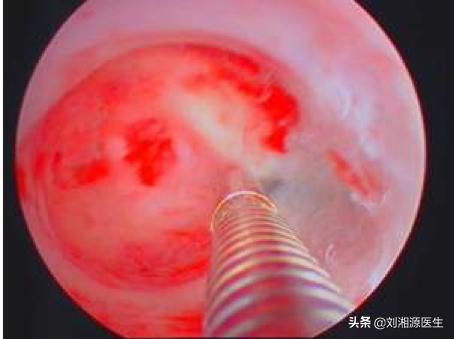 免疫治疗不良妊娠的方法,宫腔粘连合并妊娠