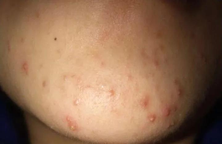 皮肤科医生最喜欢的痘痘