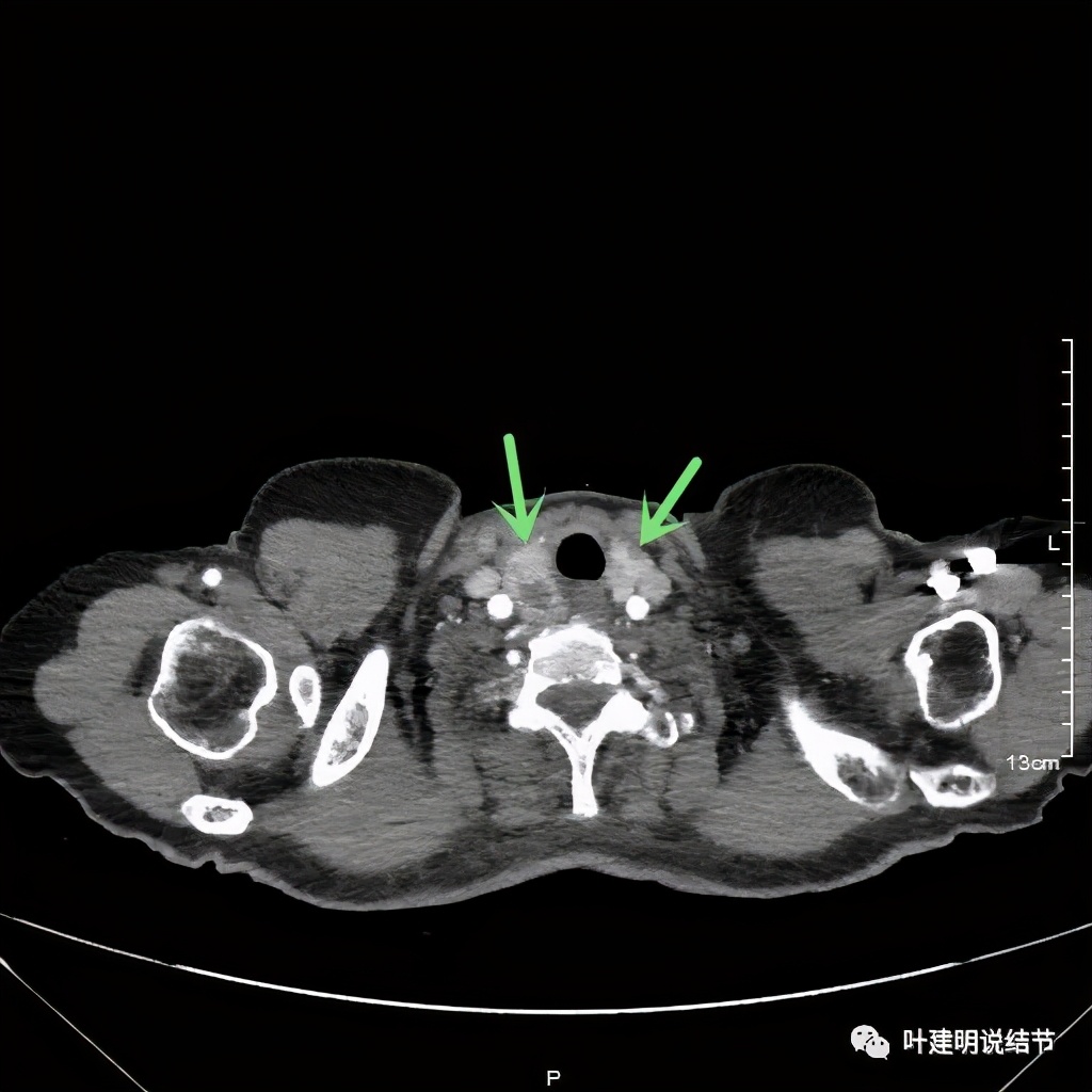 胸部高分辨ct检查注意事项,胸部ct扫描有没有危害