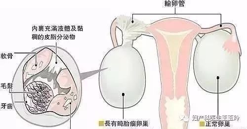 畸胎瘤为什么有毛骨头,51岁女子肚子里有畸胎瘤吗