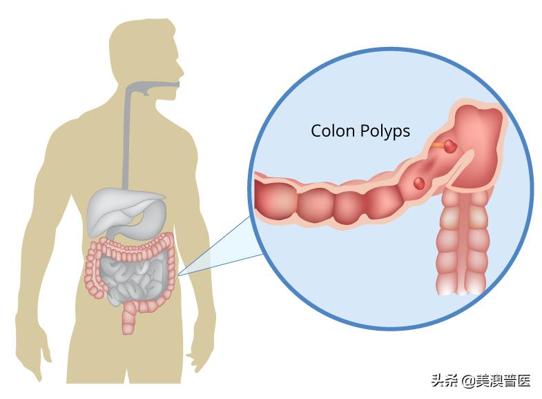 肠息肉大于2cm可以肠镜切除干净吗,肠息肉切除的几种方法