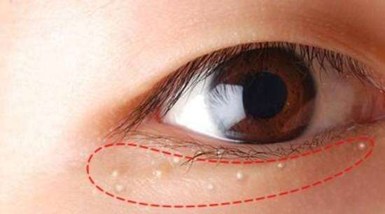 眼周围有脂肪粒怎么护肤最好呢,怎么去眼周脂肪粒最有效的方法