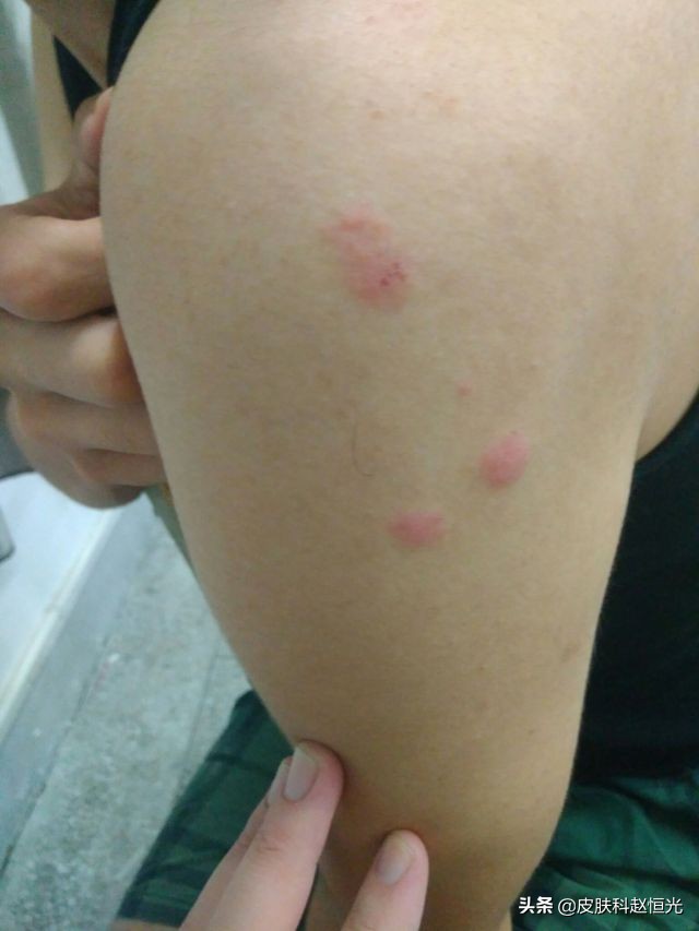 身上突然起了很多红包很痒怎么办,身上长红包奇痒难忍