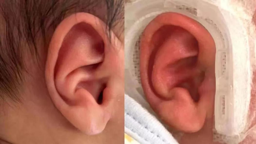 新生儿耳廓畸形需要抹什么药定型,新生儿耳朵轮廓畸形家长怎么办