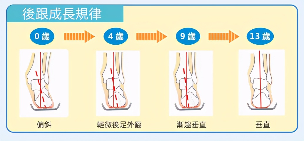 儿童足型发育,儿童足外翻x型腿内八字