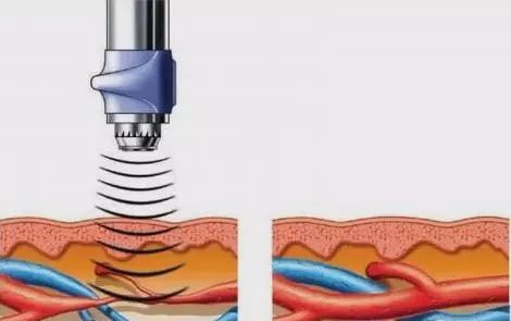 龙之杰体外冲击波疼痛治疗仪,体外冲击波疼痛治疗仪