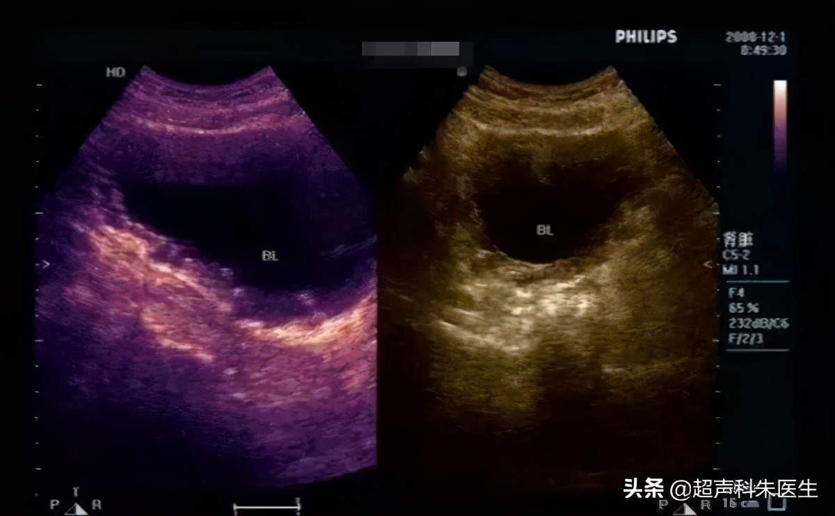 特殊性膀胱炎超声表现,特殊性膀胱炎吃什么药