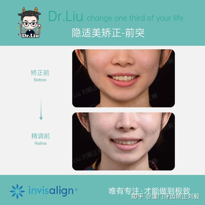 牙齿矫正厦门口腔医院,厦门隐形龅牙矫正优惠