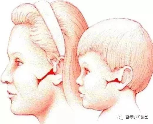 儿童突然中耳炎耳朵疼什么原因,半夜急性中耳炎怎么办