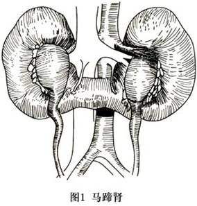 常见的先天性肾脏畸形,先天性肾发育不良肾是什么样的