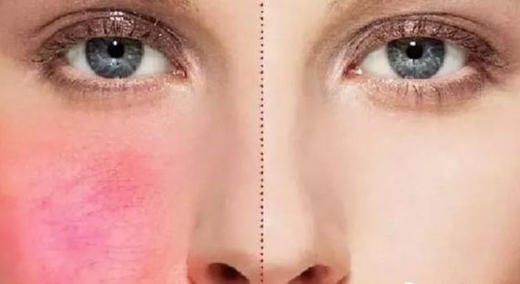 红血丝皮肤护理方案话术,红血丝肌肤的护理方法