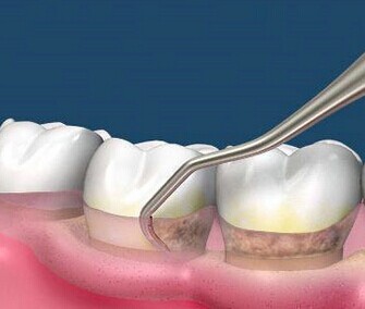 牙齿松了如何固齿,撞松牙齿松动了怎么样才能固齿