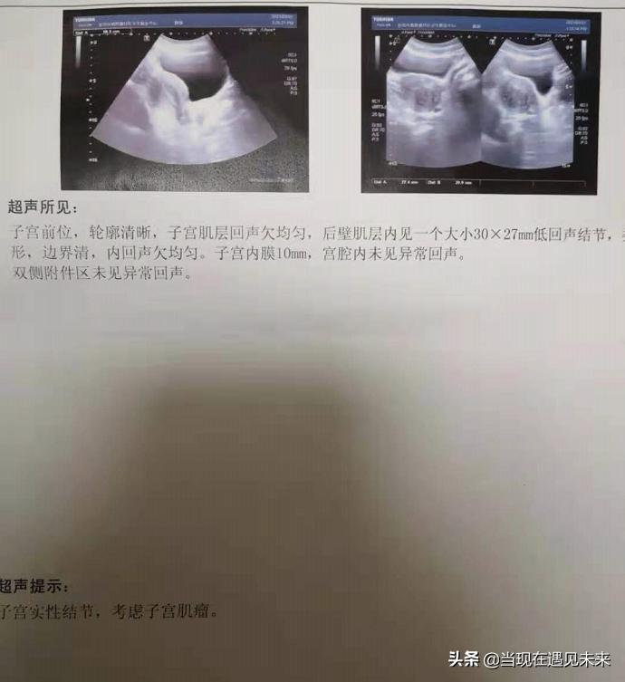 42岁子宫肌瘤备孕两个月没怀孕,备孕子宫肌瘤4厘米