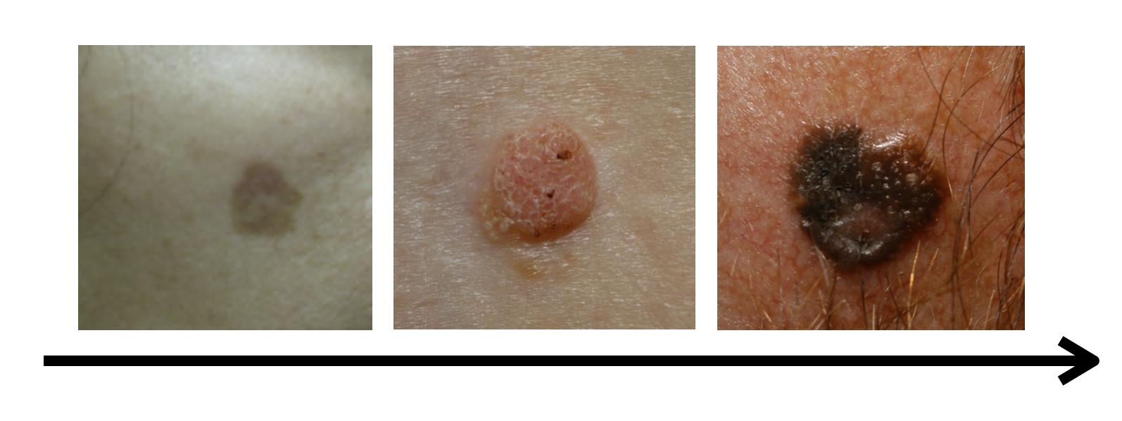 老年斑预示体内什么病,老年斑预示着什么