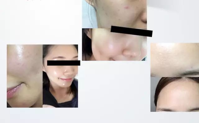 毛孔粗大皮肤暗黄该怎么改善肤质,毛孔粗大肤色暗沉应该怎么改善