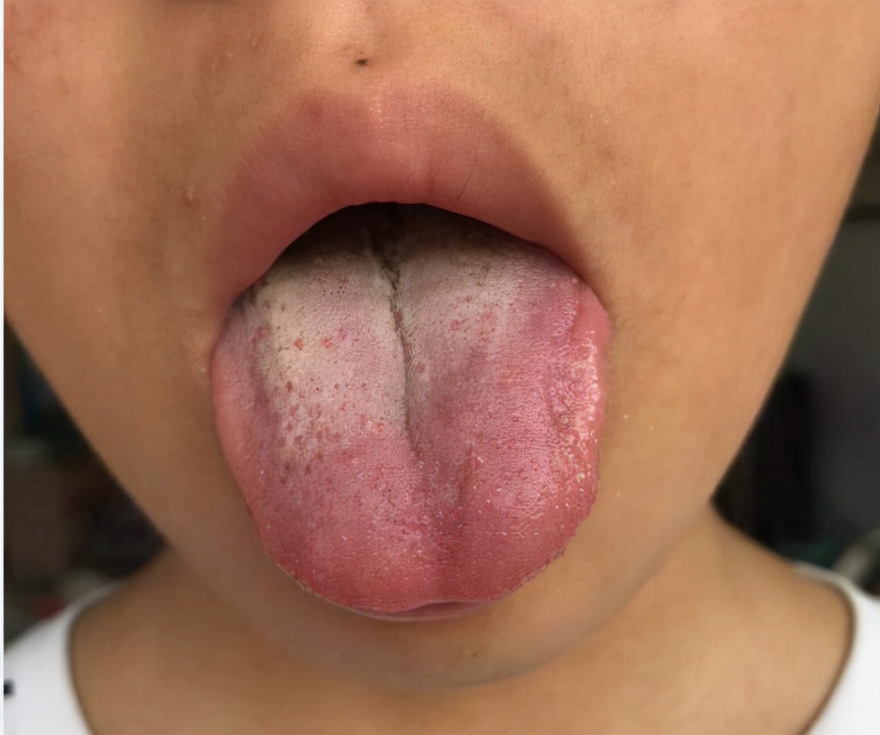 上热下寒引火归元中药方,上热下寒用什么中药最好