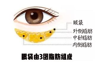 眼袋消除三个方法,教你一个简单消除眼袋的方法
