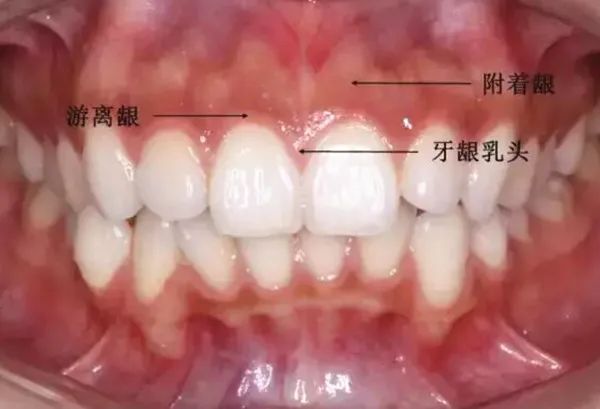 牙齿矫正中出现的黑三角会恢复吗,牙齿矫正后牙龈出现黑三角怎么办