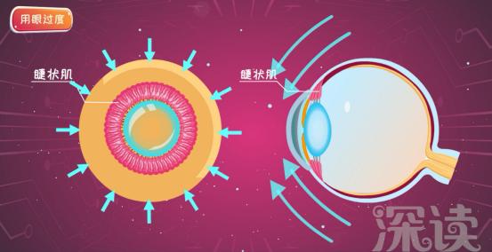 儿童保持近视度数的最好办法,儿童近视越小越好治吗