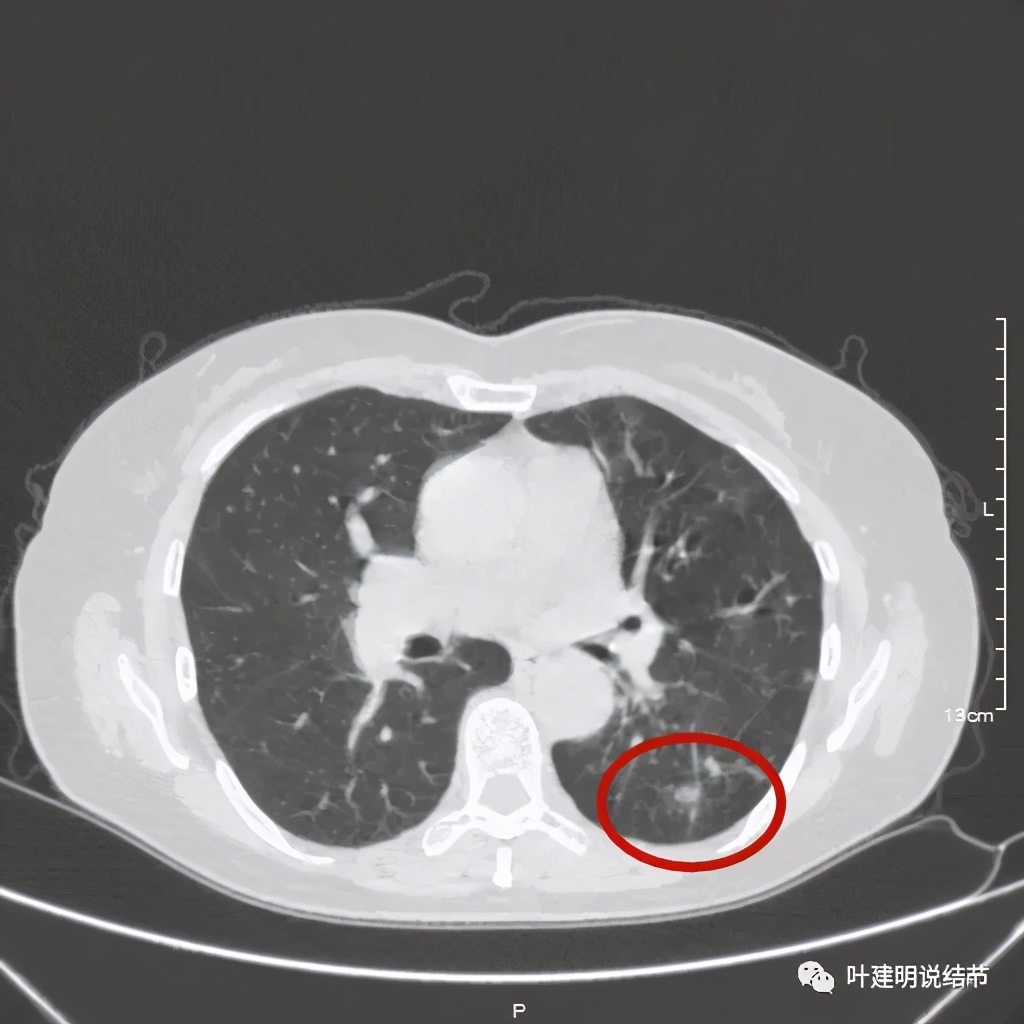 这样的实性结节伴小空洞会是肺癌吗?