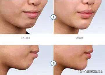 有几种下巴,有三个下巴是为什么