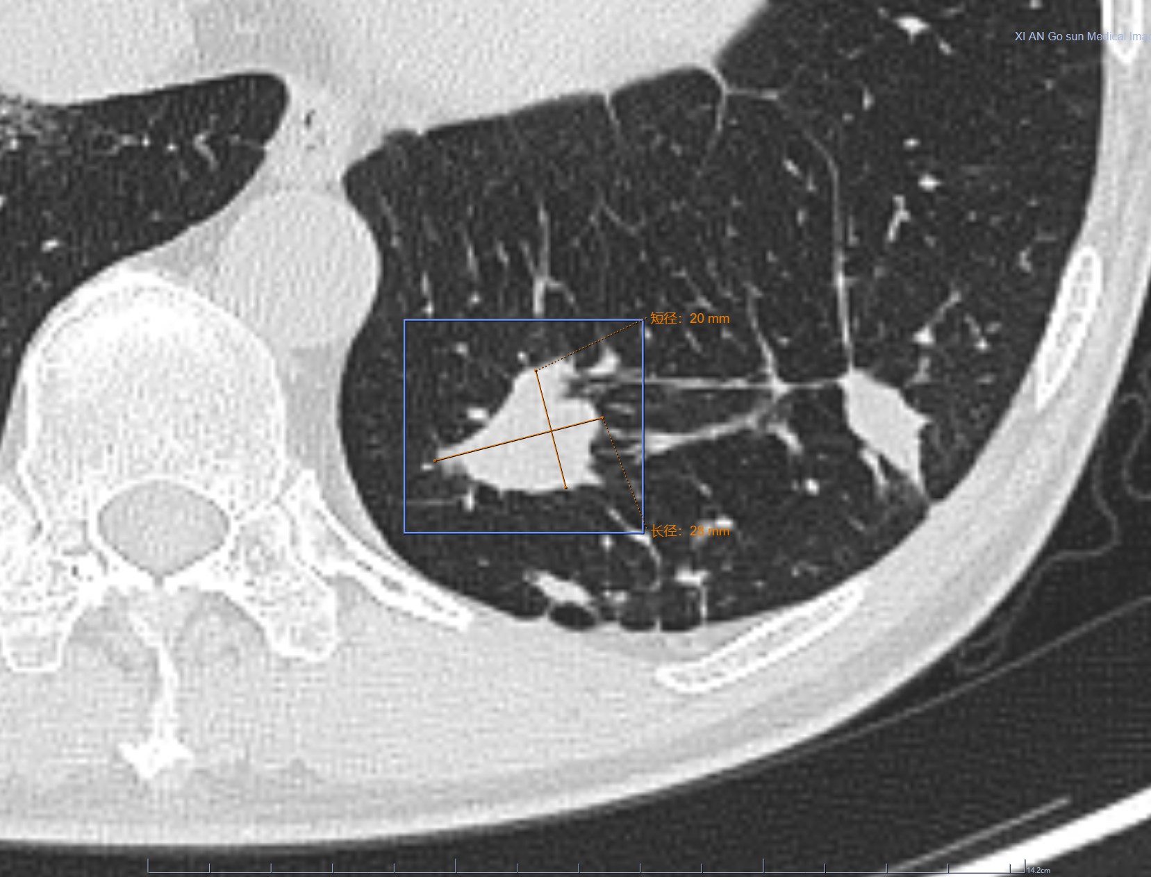 9mm肺结节实性结节良性几率多大,良性肺结节生长速度