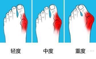 太原中心医院汾东院区骨科,太原汾东中心医院骨科拇外翻大夫