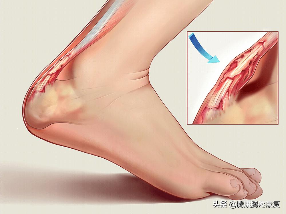 跟腱炎临床诊疗指南,跟腱炎起因和治疗