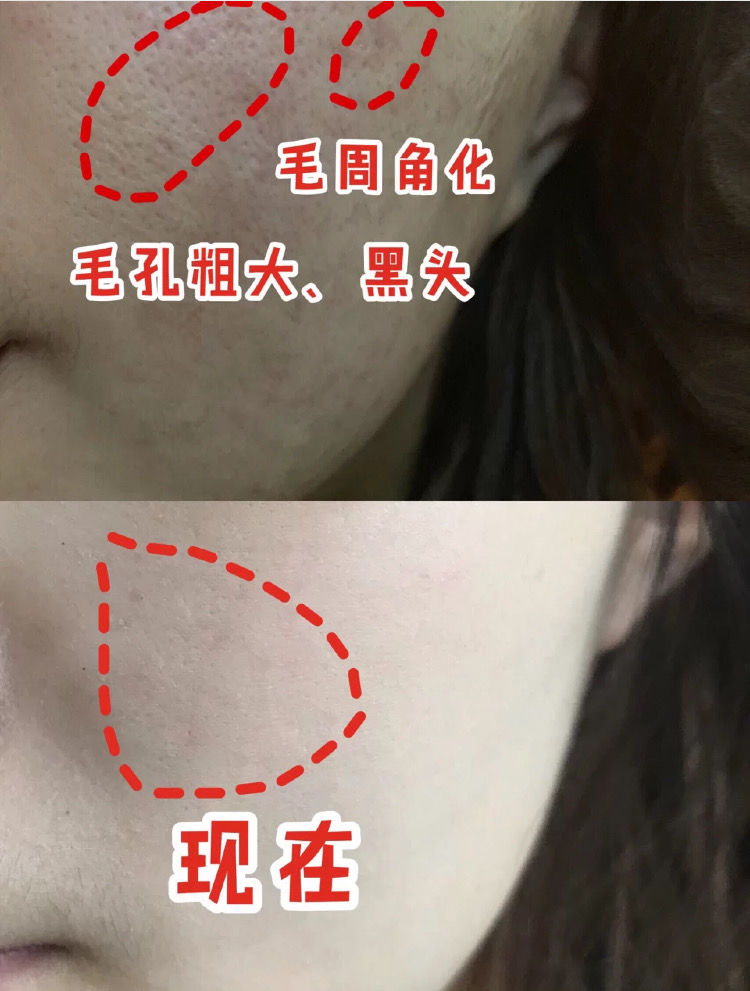 维生素b6软膏可以祛黑头缩毛孔吗,b6维生素敷在脸收缩毛孔吗