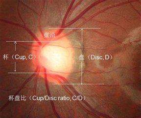 杯盘比是面积比吗,杯盘比大于0.6一定是青光眼么