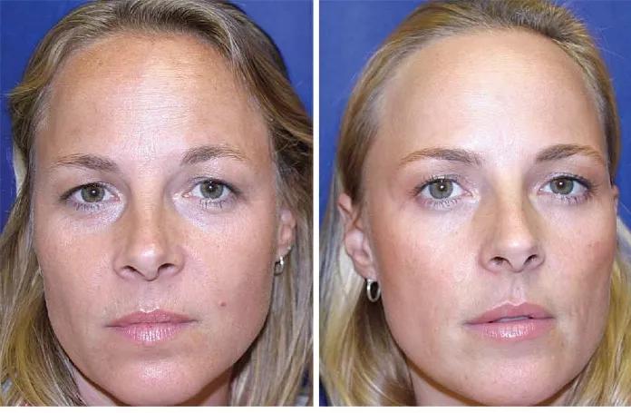 医美肉毒素科普,肉毒杆菌医美科普