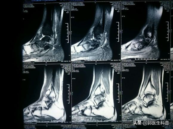 脚扭伤不敢着地怎么治疗,脚扭伤不尽快处理
