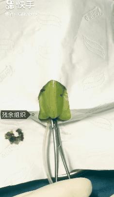 香蕉割包皮,洋葱剖腹产?这是我见过最秀的医生