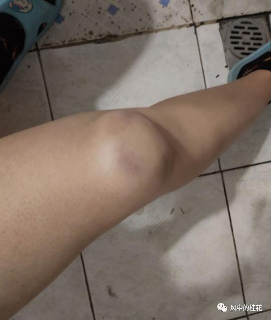 溜冰摔了膝盖关节处肿了,溜冰摔倒了膝盖不能弯曲