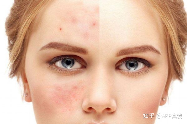 使用水杨酸后皮肤泛红,抹完水杨酸后需要补水吗