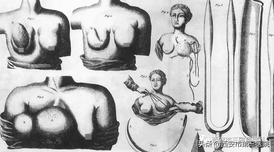 乳腺癌治疗史的不断演进,中医讲乳腺癌的真实故事