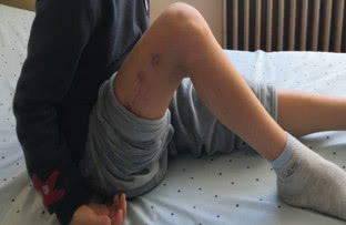 6岁男孩被车撞脚踝骨骨折,六岁男童摔伤后续