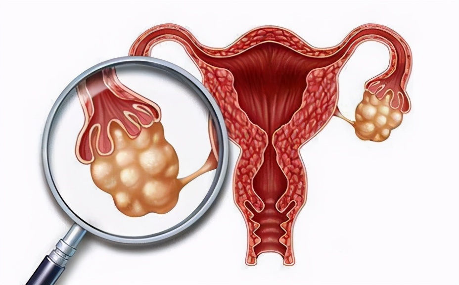 卵巢囊肿能吃鱼么,卵巢囊肿能吃什么不能吃什么