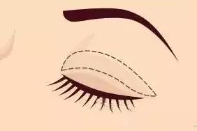 全切无痕割双眼皮,全切双眼皮原来是这么割出来的