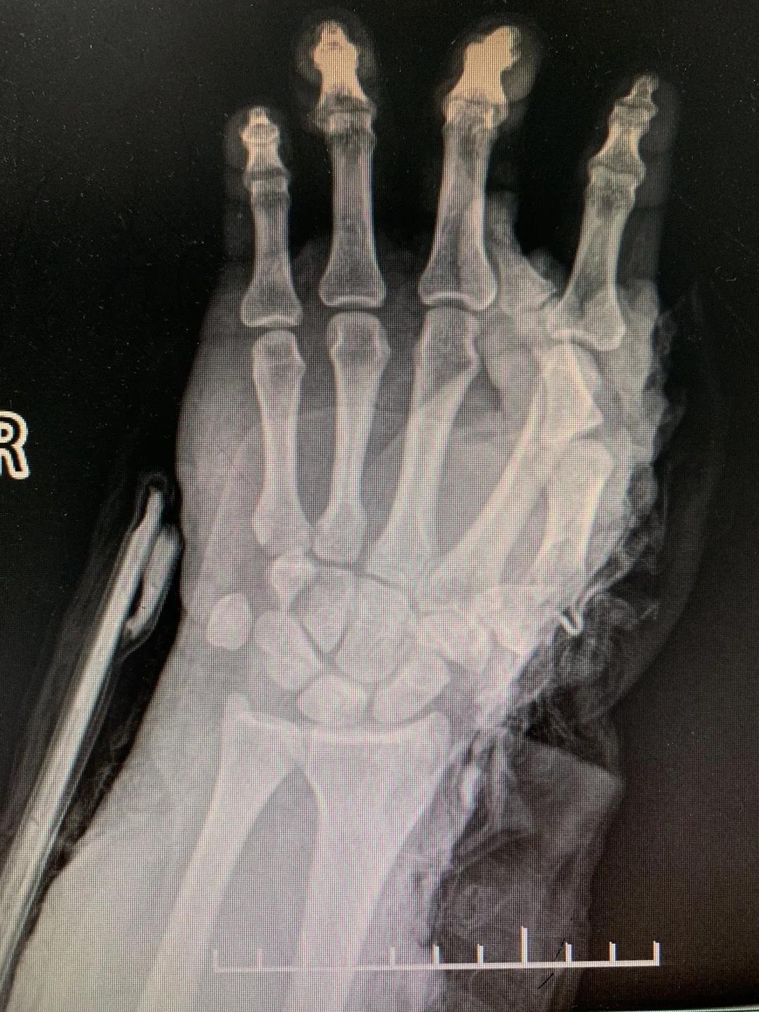 【日照市人民医院】右臂卷入机器被撕裂 6.5小时成功复活