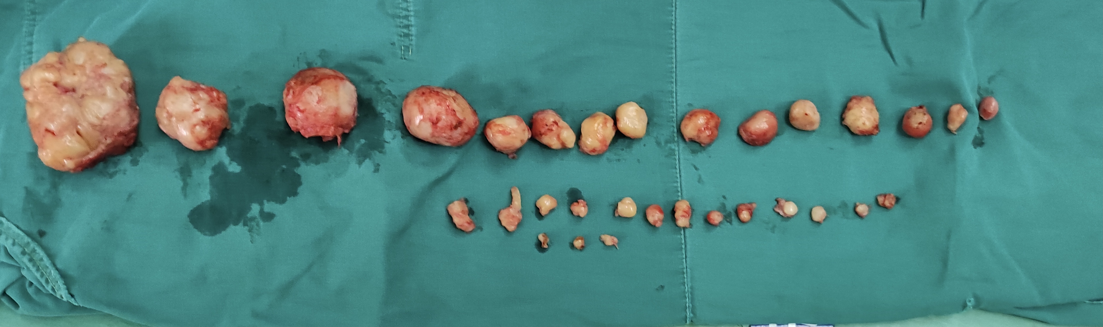 40岁多发子宫肌瘤开腹手术,10多厘米的子宫肌瘤的手术成功率