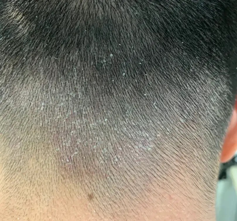 头上长头皮屑怎么办三分钟搞定,头上长凸起的疙瘩抠下来像头皮屑