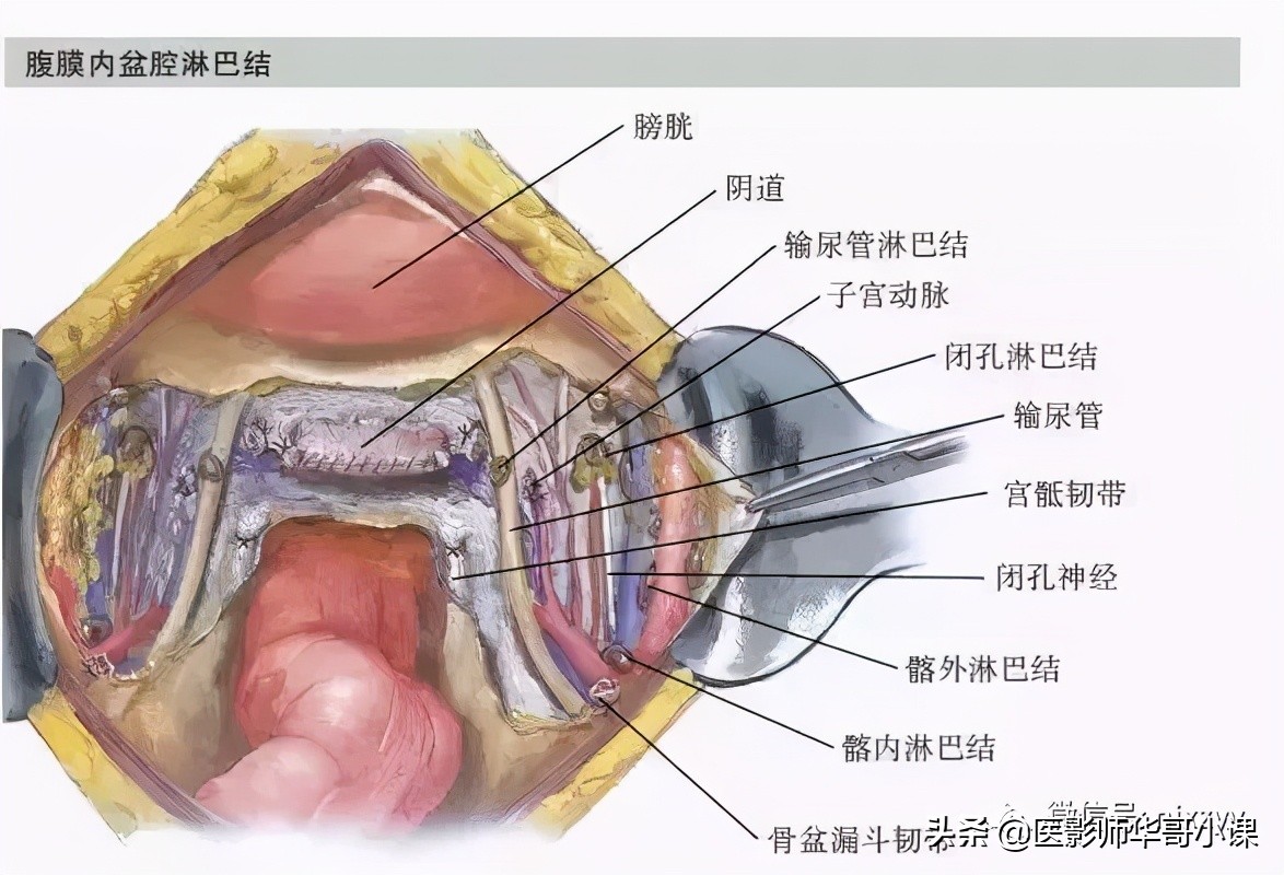 盆腔积液ct解剖图谱,盆腔解剖图谱手绘步骤