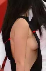 超模收副乳,超模消除副乳