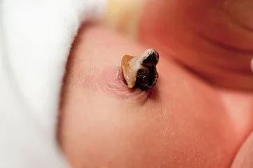 新生儿脐带未脱落发臭怎么办,新生儿的脐带边上发红怎么回事
