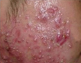 原来脸上的痘痘取决于心情,原来痘痘反复长是这些原因导致的